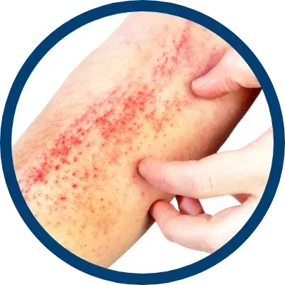 Allergic Contact Dermatitis 